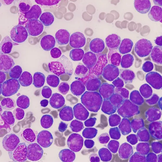 Acute Myeloid Leukemia (AML) Comboquest 8